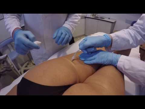 Dorsale protrusione discale toracica Intorpidimento delle guance con osteocondrosi cervicale