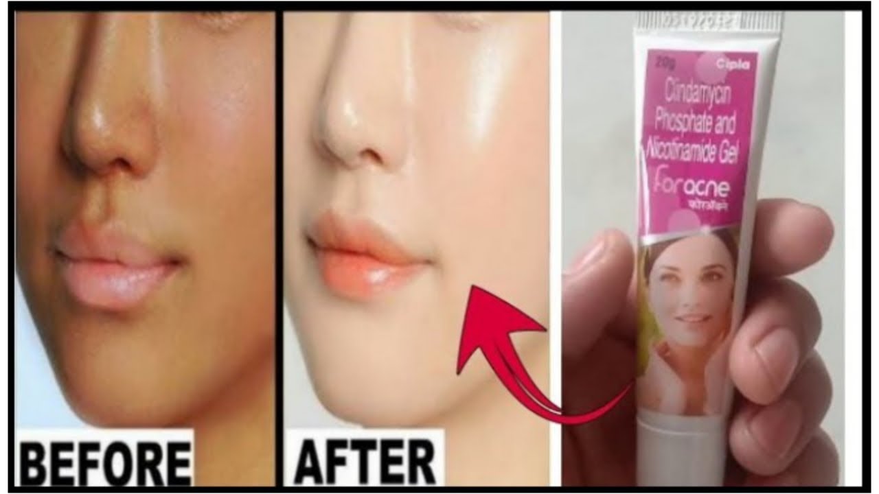 Watch video चेहरा गोरा करें | Chehra gora kare | Foracne Cream | Medicine News Now चेहरा गोरा करें | Chehra gora kare | Foracne Cream | Medicine News