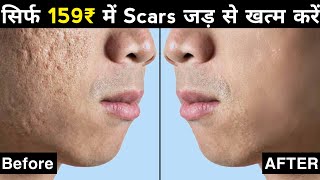 Acne Scars के 3 Treatment | How To Remove Pimples Holes, Scars [Hindi]