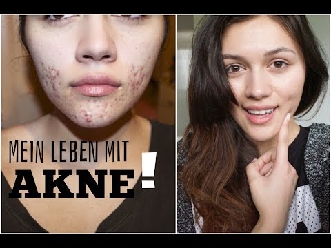 Die Behandlung die Schuppenflechte auf des Gliedes Nejrodermit der Hände der Hände