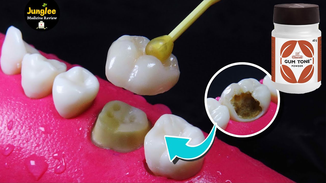 Watch video Charak gum tone powder review AMAZING restoration of tooth damaged by caries: Crown in 4K Now Charak gum tone powder review AMAZING restoration of tooth damaged by caries: Crown in 4K