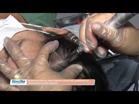 Microagulhamento: Procedimento capilar traz surgimento de novos fios no couro cabeludo 28 09 2022