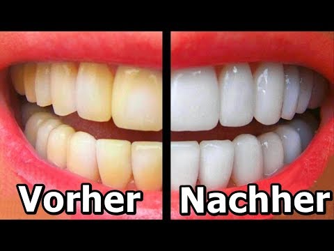 Vorsicht, diese 7 Lebensmittel machen gelbe Zähne