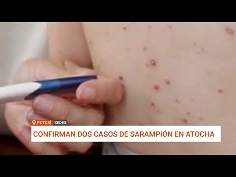 DOS NUEVOS CASOS DE SARAMPIÓN EN POTOSÍ