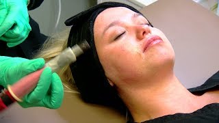 Microneedling procedure at CEI lifts skin in 30 minutes