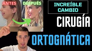 CAMBIÓ su CARA por completo - CIRUGÍA ORTOGNÁTICA
