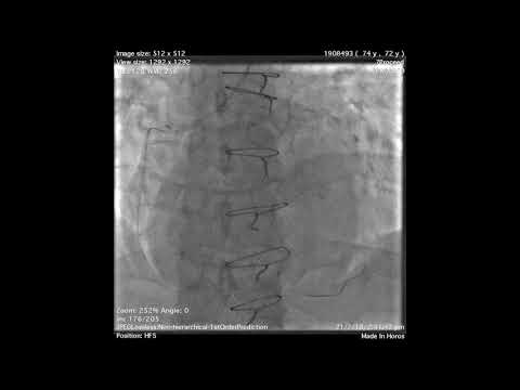 Distal wire perforation in Vein Graft PCI