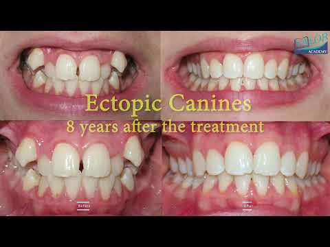 Trailer of Ectopic Canines in 4K!