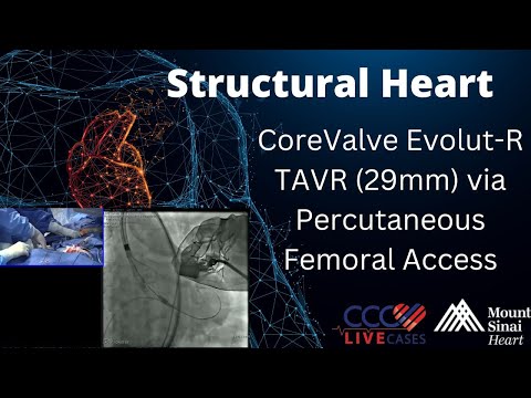 CoreValve Evolut-R TAVR (29mm) via Percutaneous Femoral Access Structural Heart - August 23, 2016