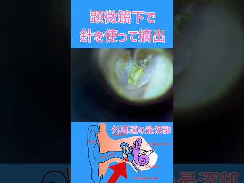 適切な耳掃除:多くの人はこれにさえ注意を払っていません