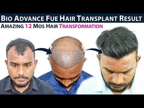 Amazing 12 months Hair Transformation || Bio Advance FUE hair transplant result || HFHG Clinic