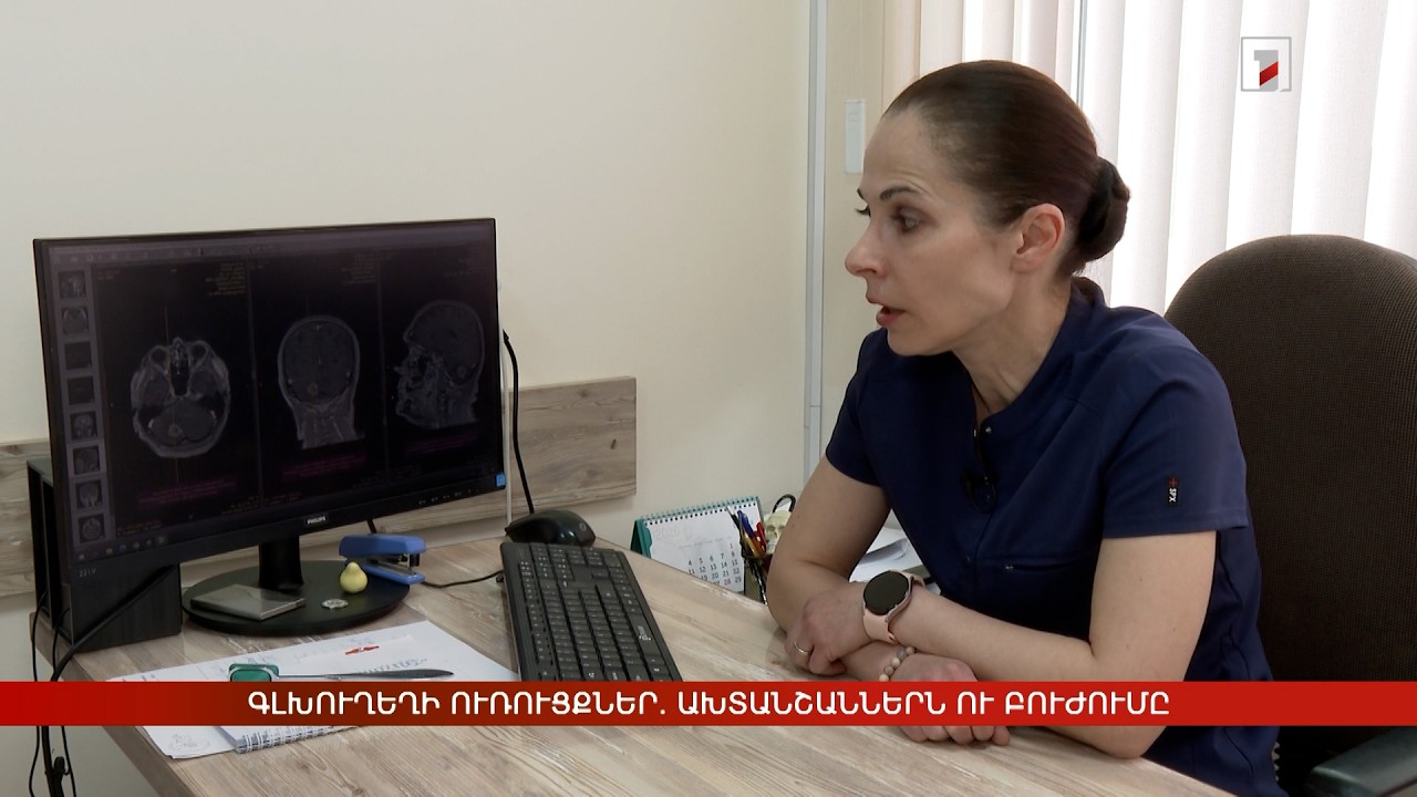 Գլխուղեղի ուռուցքներ. ախտանշաններն ու բուժումը