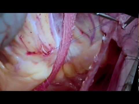 Jeden Tag unter dem Hals weh tut Lorbeerblatt therapeutischen Eigenschaften Osteochondrose