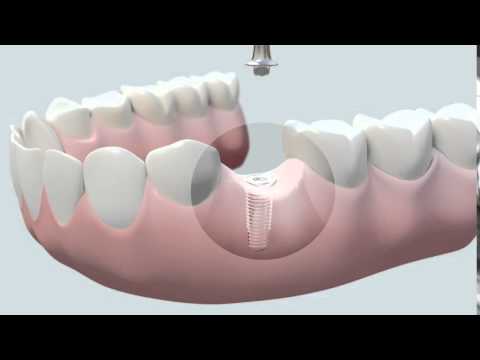 Cómo se coloca un implante dental