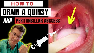 How to drain a QUINSY (aka peritonsillar abscess): A Step-by-step guide | Doctor O