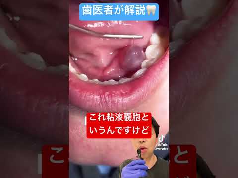 魅力的な!歯が生えた恐ろしい「怪物腫瘍」の正体はこれだ