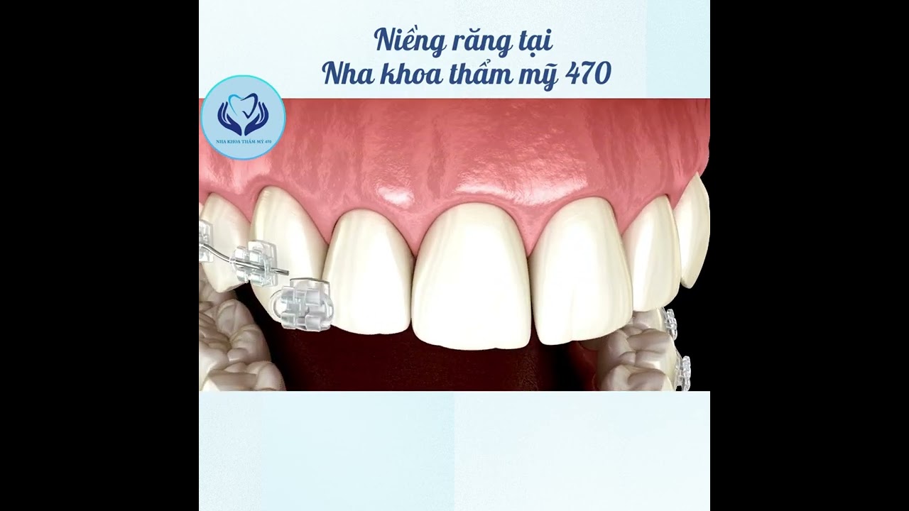 Niềng răng không đau - Nha khoa không đau
