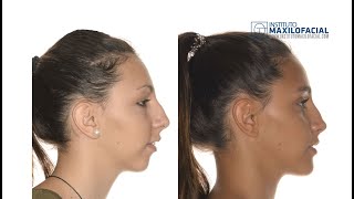 Cirugía ortognática bimaxilar. Mentoplastia. Caso #37: Gemma - Clase 2, mordida abierta