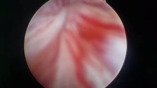 Cystoscopy for BPH with prostatic calcification by Dr. N. Satya prasad M. S , M ch