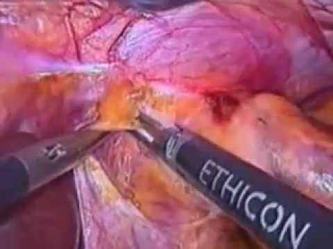 comment soigner une hernie hiatale