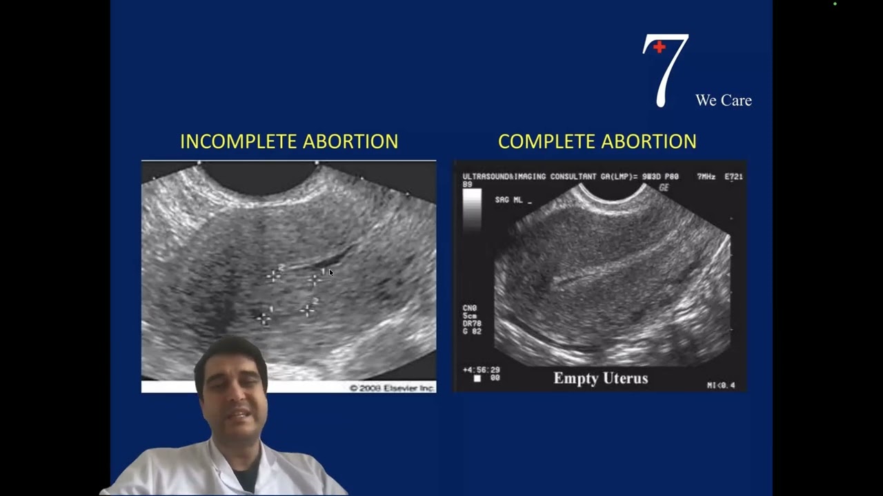 Bleeding in early pregnancy