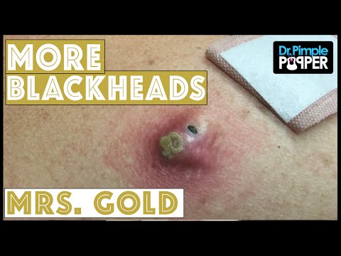Back Blackhead Extraction Session #2 in "Mrs Gold"-Addressing the Inflamed One