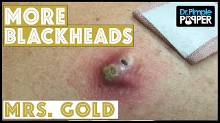 Back Blackhead Extraction Session #2 in &quot;Mrs Gold&quot;-Addressing the Inflamed One