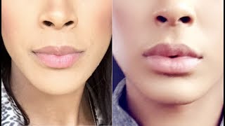 1 SYRINGE OF JUVEDERM LIP FILLERS BEFORE & AFTER | DR. ELIOT BATTLE CULTURA