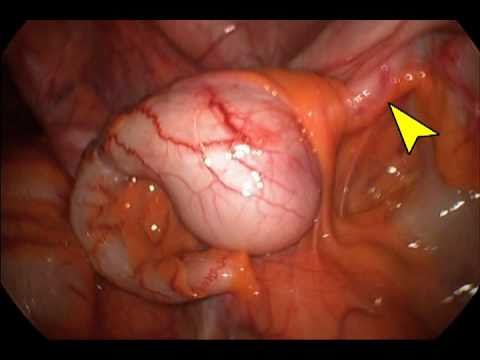 5 Centimeters Appendiceal Fecolith - Laparoscopic Excision