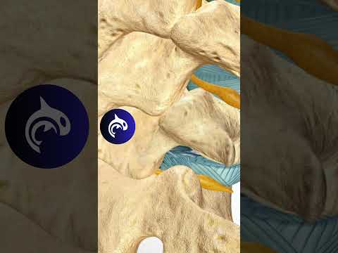 Lumbar Microdiscectomy of the Spine - See How It Works - 3D Animation #4k #backpain #chronicpain