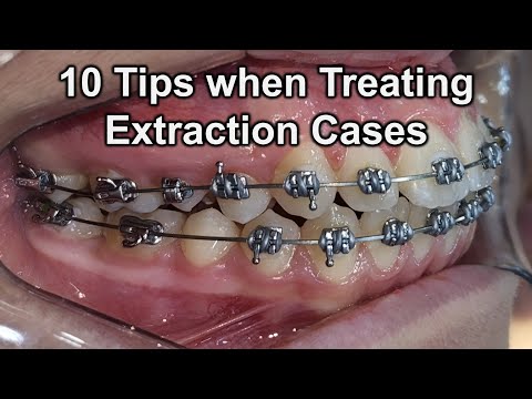 10 Tips when Treating Extraction Cases