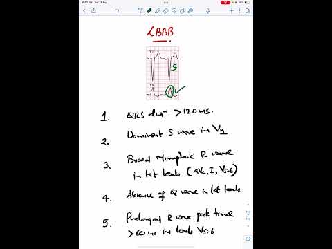 LBBB ECG Criteria | Left Bundle Branch Block