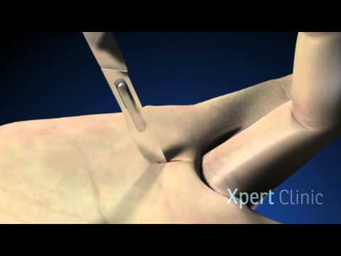 Triggerfinger operatie - Xpert Clinic