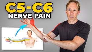 C5-C6 Disc Injury Exercises