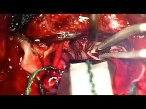Virus del papiloma uretral