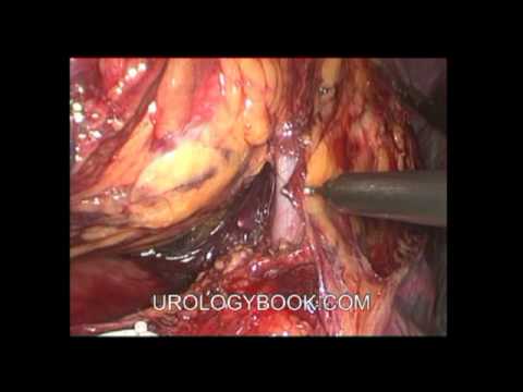 Laparoscopic Radical Nephrectomy