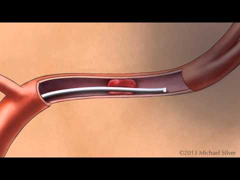 Treatment of Acute Ischemic Stroke with Clot Retrieval Device
