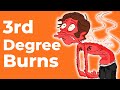 3rd Degree Burns: Everything You Should Know | Wound Care OC