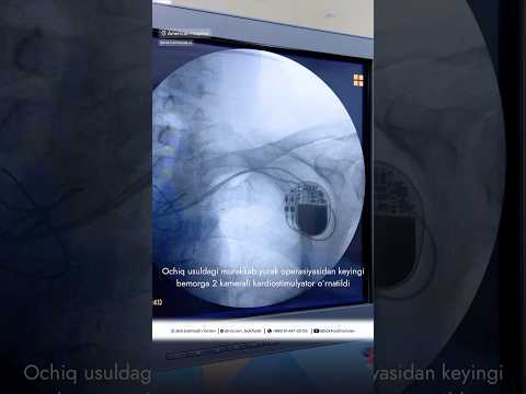 Aritmiya Murojat uchun: +998 91 447-33-55 #taxikardiya #arrhythmia  #bakhodirnarziev #doctor