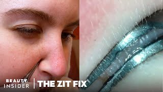 Blackhead Tweezers Under The Microscope | The Zit Fix | Beauty Insider