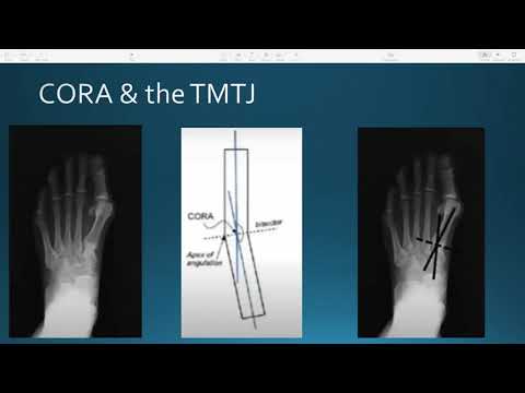 FFAFS: "A New Spin on the Lapidus Bunionectomy", 3/31/22