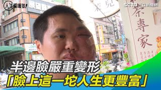 半邊臉嚴重變形「臉上這坨讓我人生更豐富」