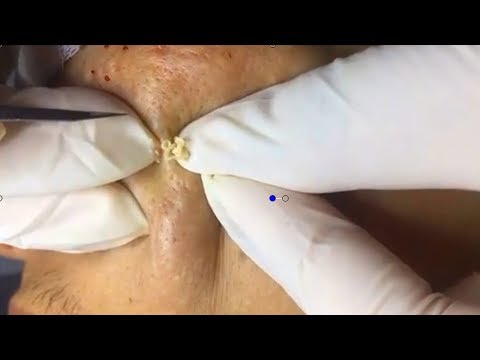 How To Remove Blackheads And Whiteheads On Face Easy #12 ✦ Dr Laelia ✦