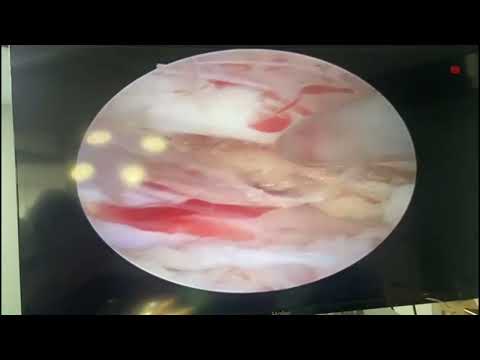 Endoscopic spine surgery - Dr Shardul Soman