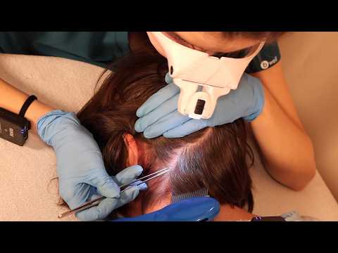 ASMR Doctor LICE Check on Scalp and Neck | Lice Removal with a Comb and Tweezers