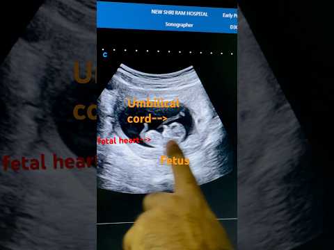 Early pregnancy ultrasound |10th week #fetal #pregnant #earlypregancy #baby #ytshorts #pregnant