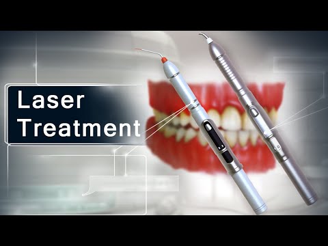 Dental Medical Animation | Benefits of LASER Treatment than Traditional Treatment