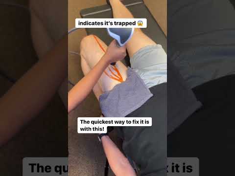 What Happens When Your Femoral Nerve Gets Stuck?