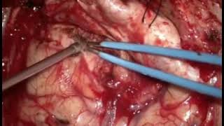 Download Lagu Temporal base meningoma. Agung Budi Sutiono, MD, PhD Thumbnail