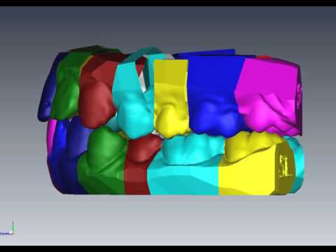 No wires no brackets for tooth straightening